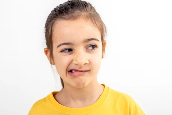 Cleft Lip and Cleft Palate