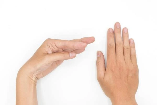 Syndactyly