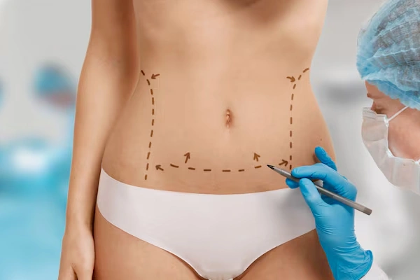 Abdominoplasty