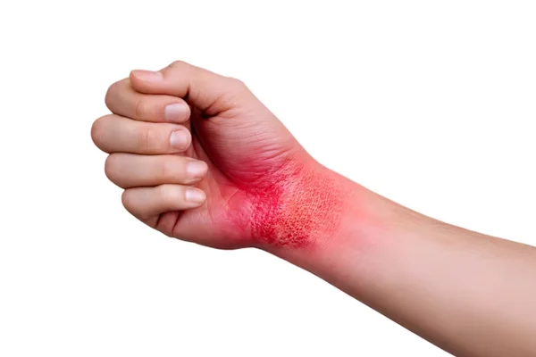 Chronic Burn