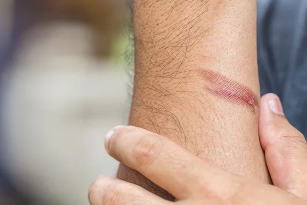Burn Scars