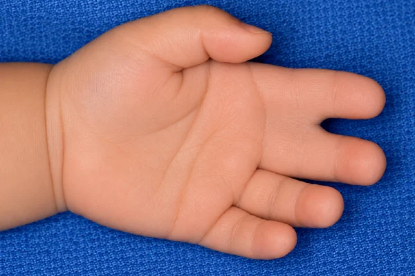Syndactyly