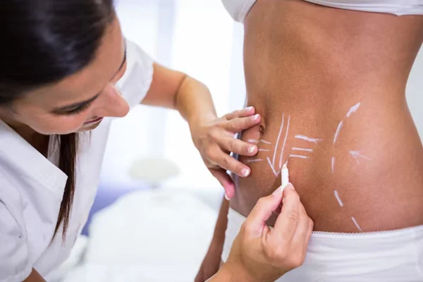 Abdominoplasty